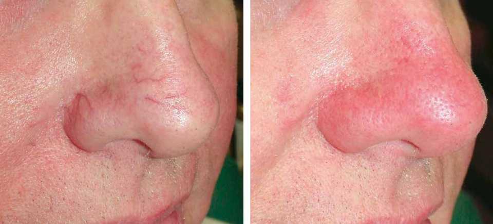 Результат до и после процедуры удаления сосудов на носу