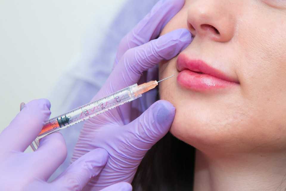 Введение гиалуроновой кислоты для увелечения губ
