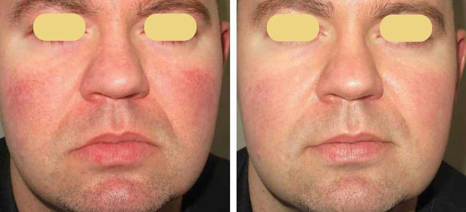 Результат до и после выполнения лечения розацеа на лице
