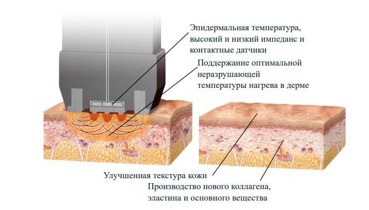 Принцип работа InMode с насадкой Forma