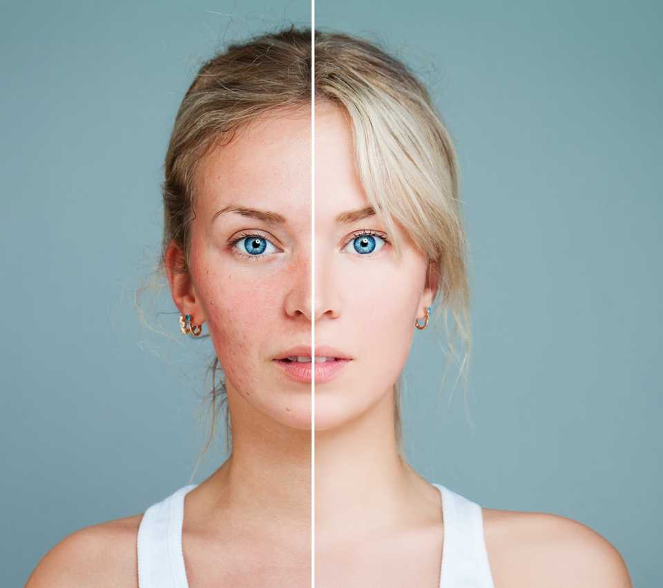 девушка с розацеа на лице, до и после лечения