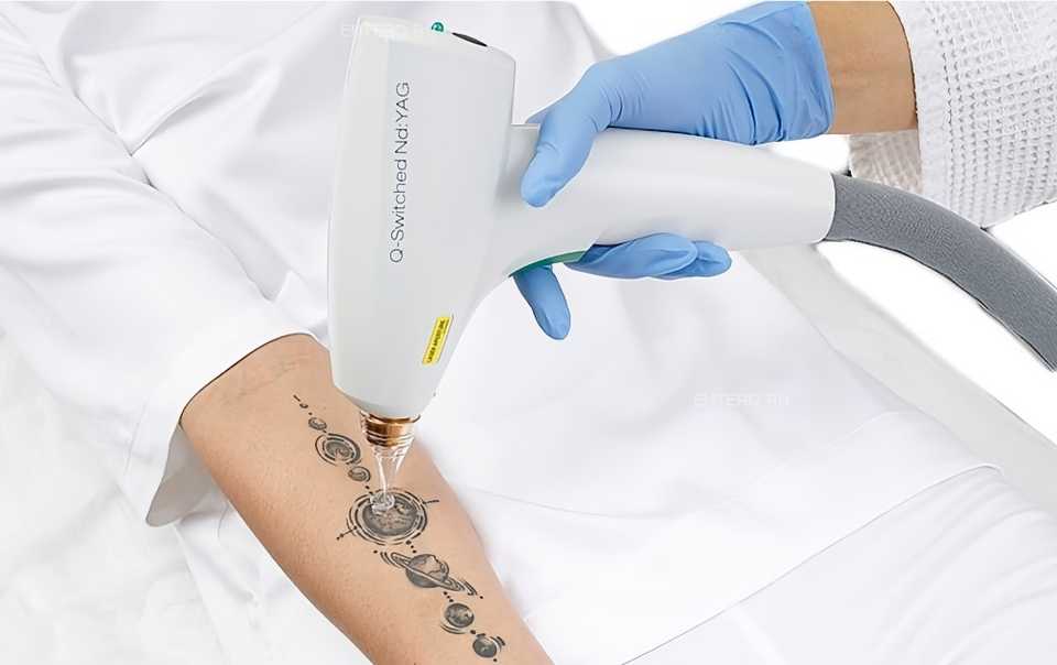 Врач удаляет татуировку пациенту лазером