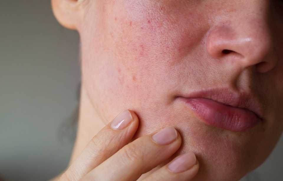 woman facial skin problems