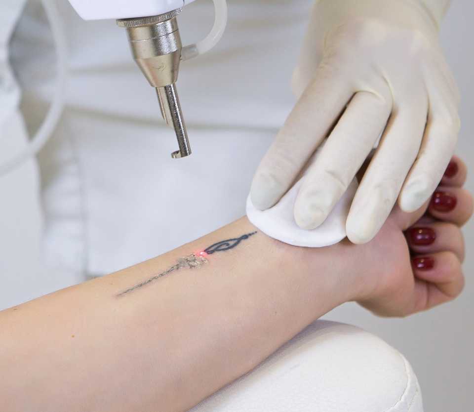 Выполнение процедуры лазерного удаления татуировки