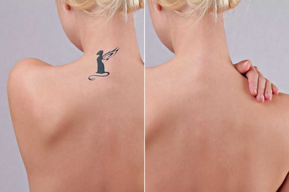 Лазерное удаление татуировки на спине