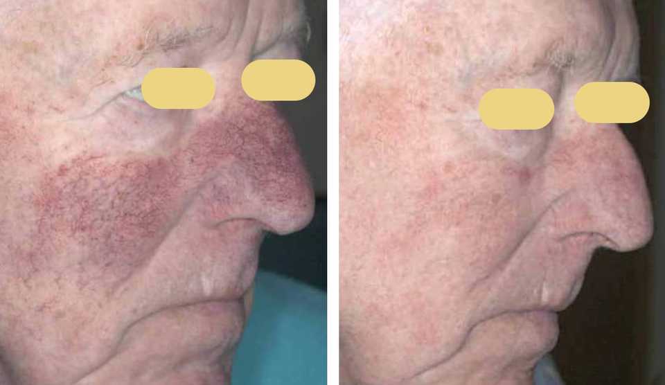 Наглядный результат до и после выполнения лечения купероза лица на аппарате Lumenis M22